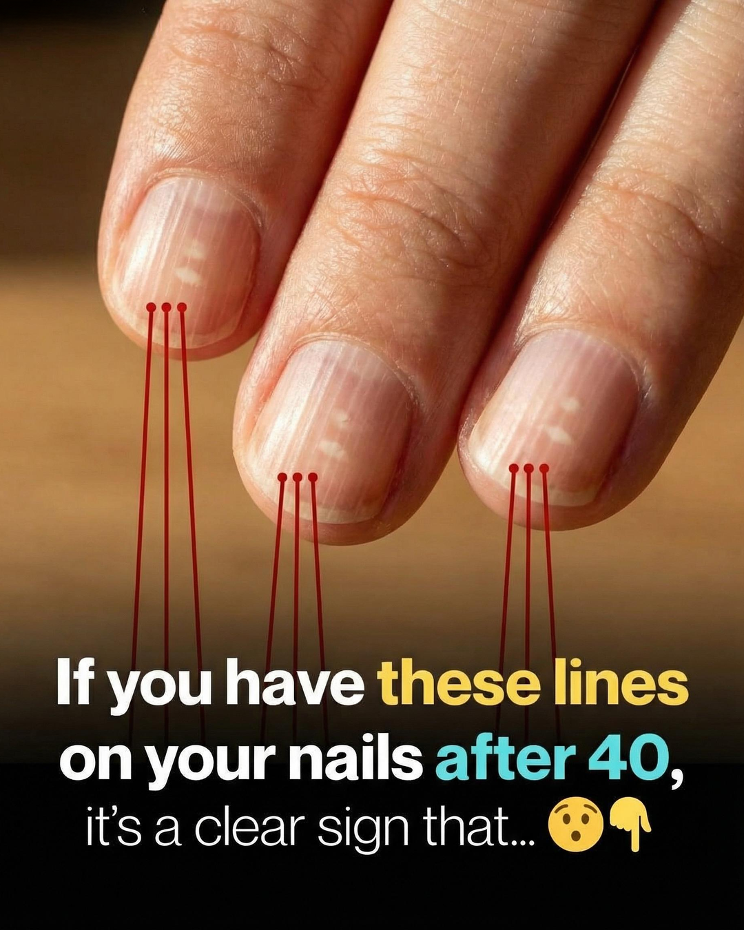 Why Vertical Lines on Your Nails Often Appear With Age