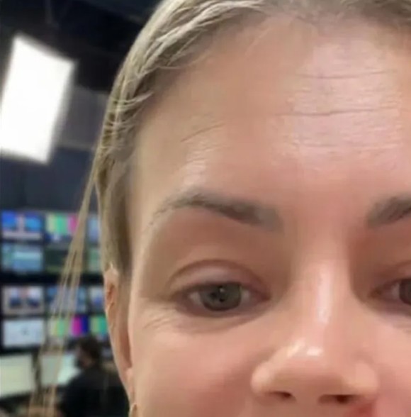 Doctors Share Important Advice About Popping Pimples in Sensitive Areas of the Face