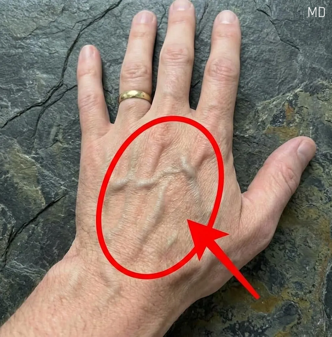 What Visible Veins Really Mean About Your Body