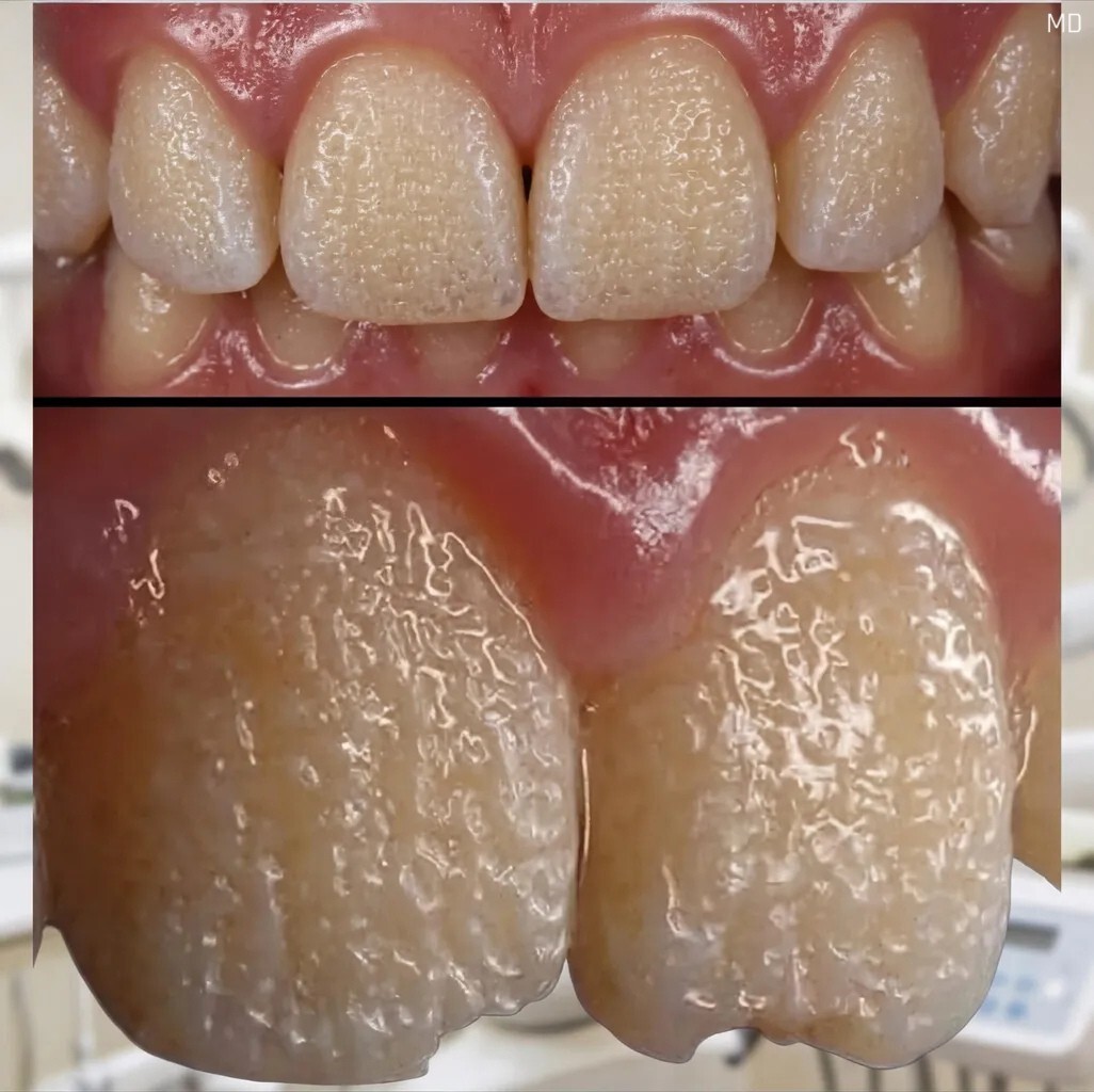 Can Rice Help Improve the Appearance of Teeth? Exploring a Popular Home Method
